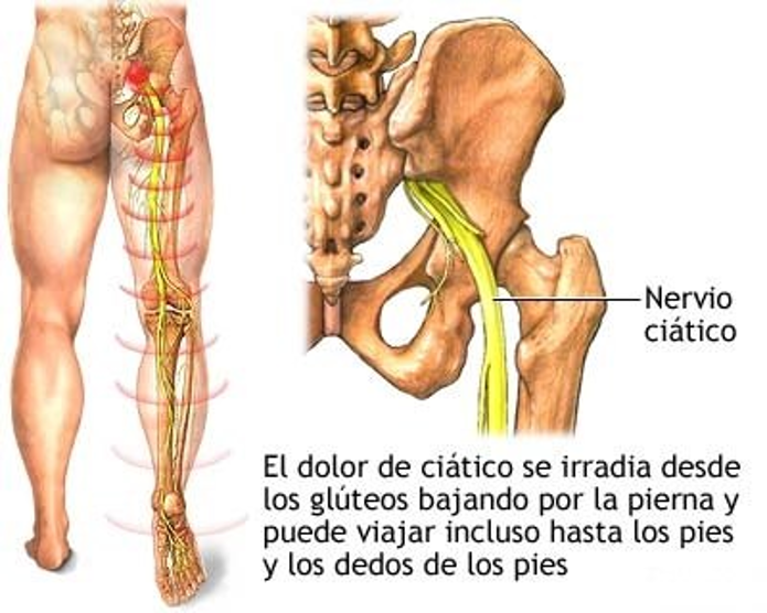 Tratamiento para dolor de nervio ciático - características