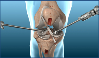 Rehabiltación de lesiones de lca - mecanismos de lesion