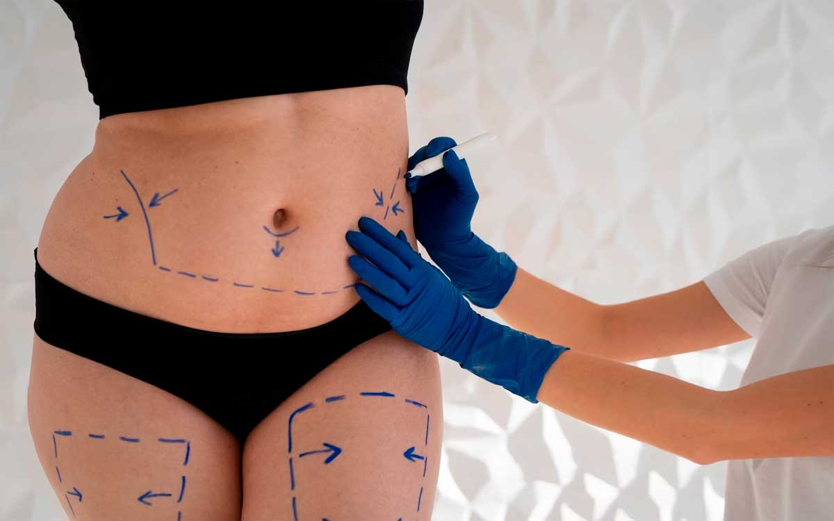 beneficios de la mesoterapia reductiva