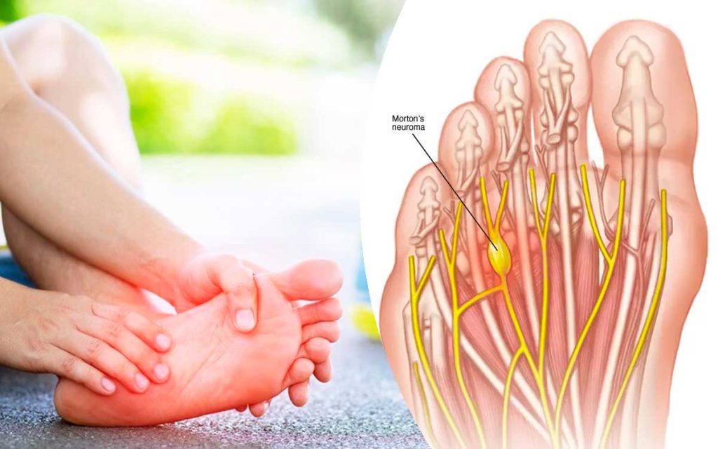 el neuroma de morton en podologia