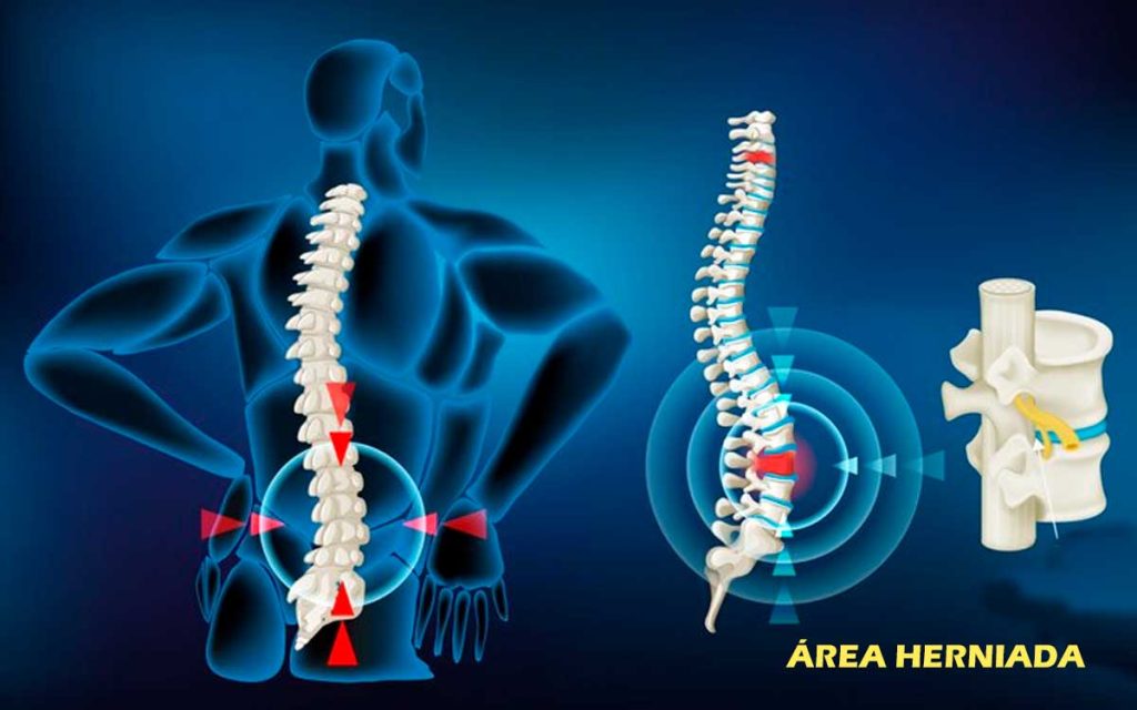 ozonoterapia para hernia